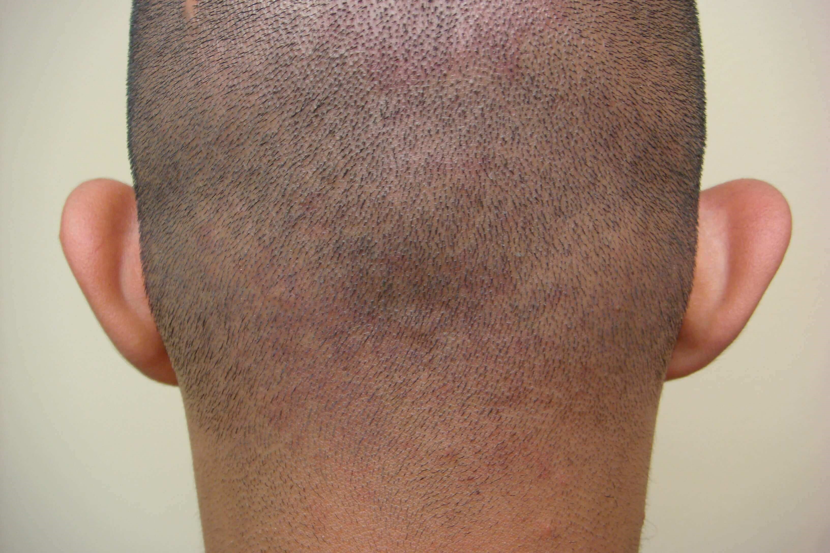 Otoplasty Before