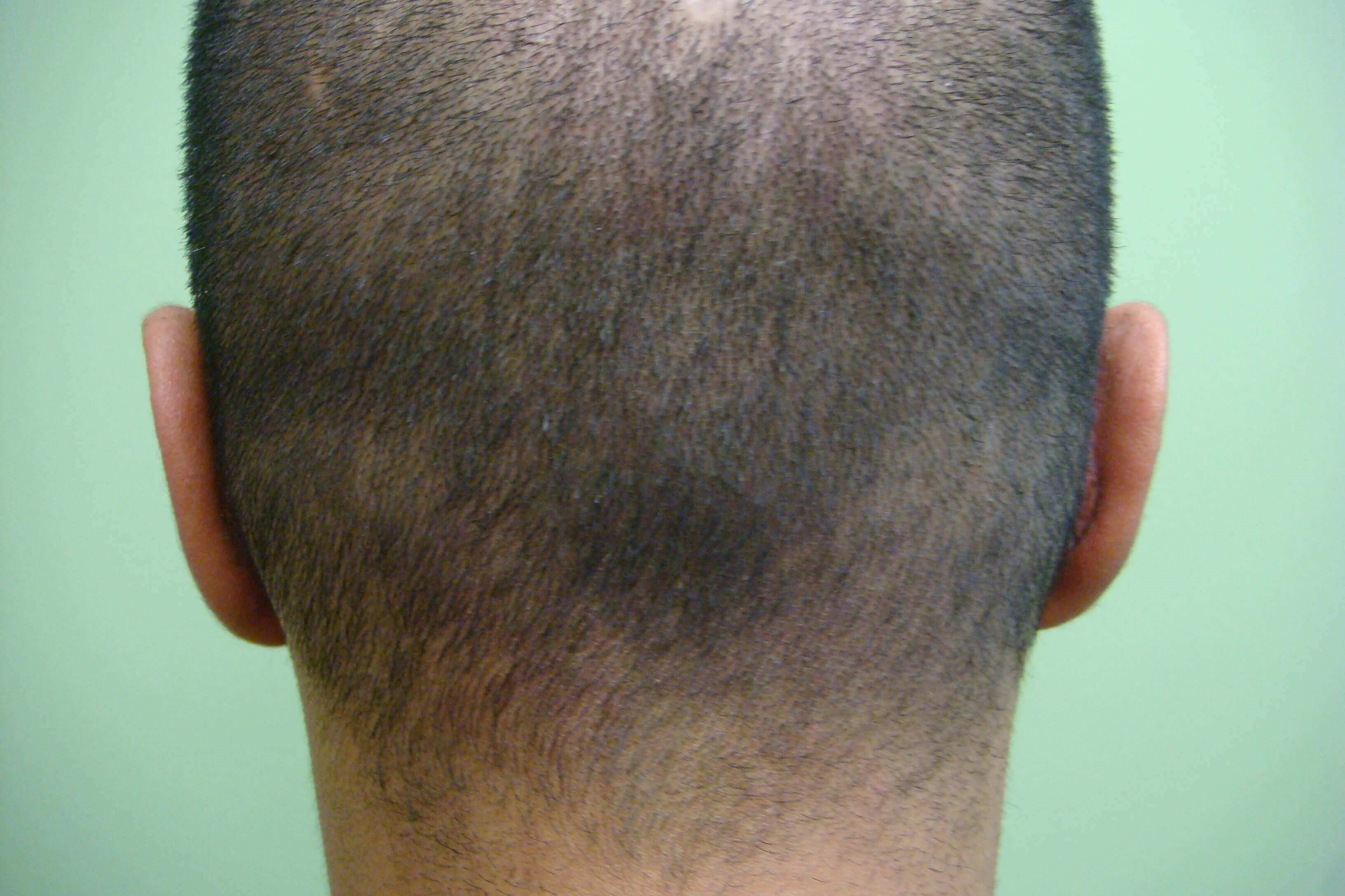 Otoplasty After