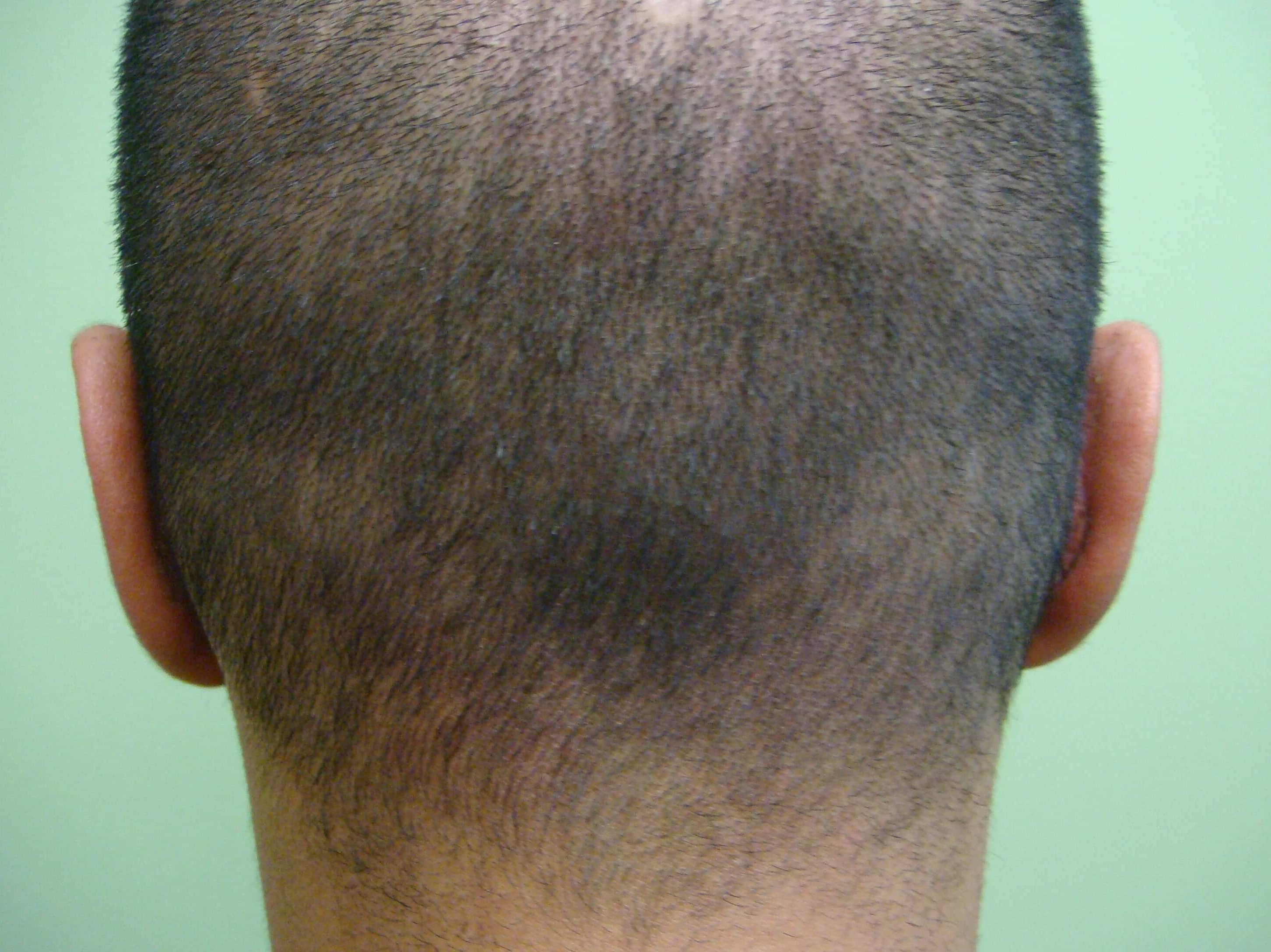 Otoplasty After