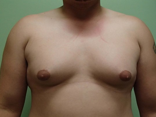 Gynecomastia (male breast redu Before