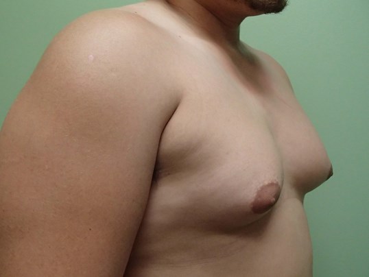 Gynecomastia (male breast redu Before