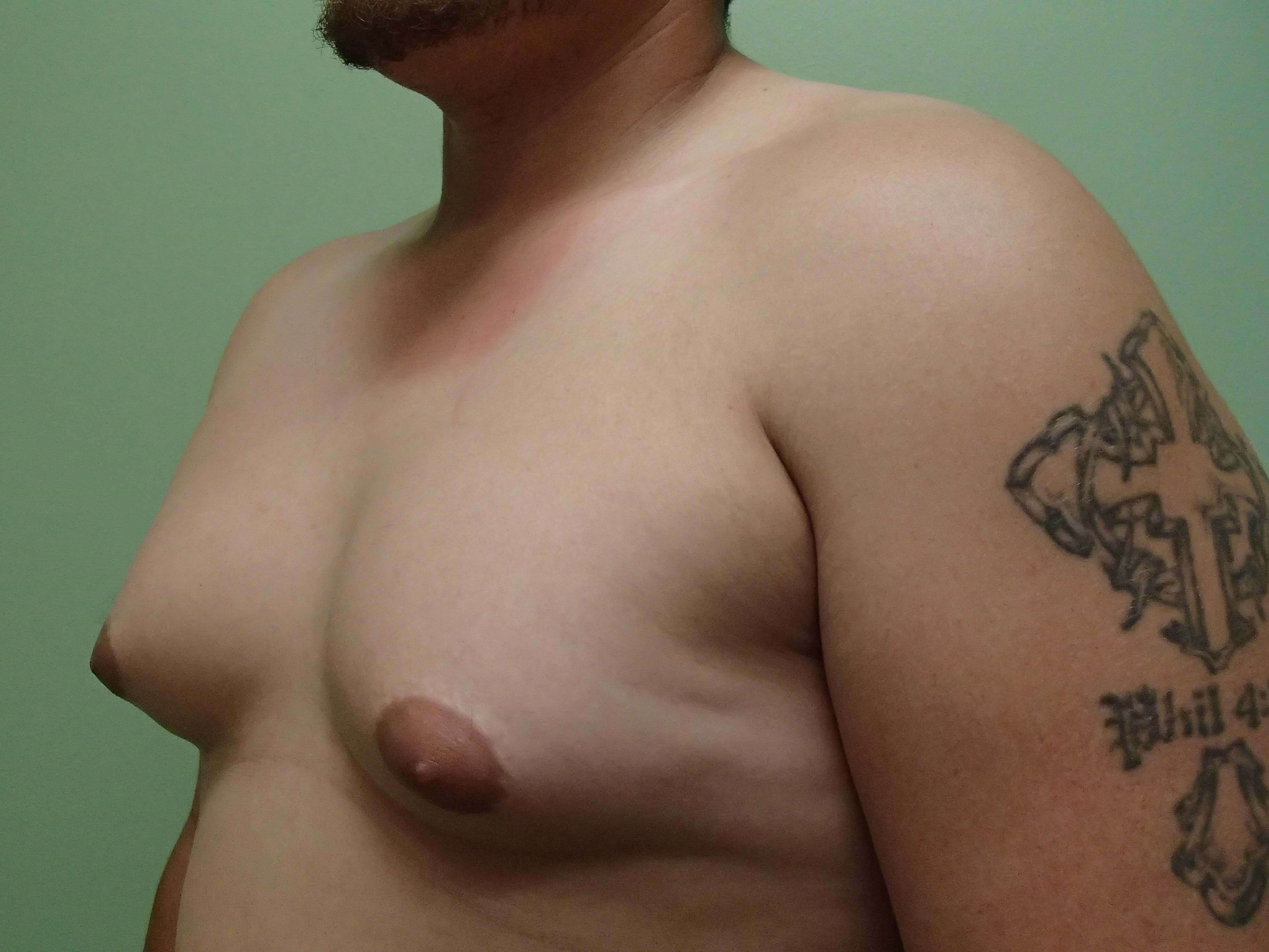 Gynecomastia (male breast redu Before