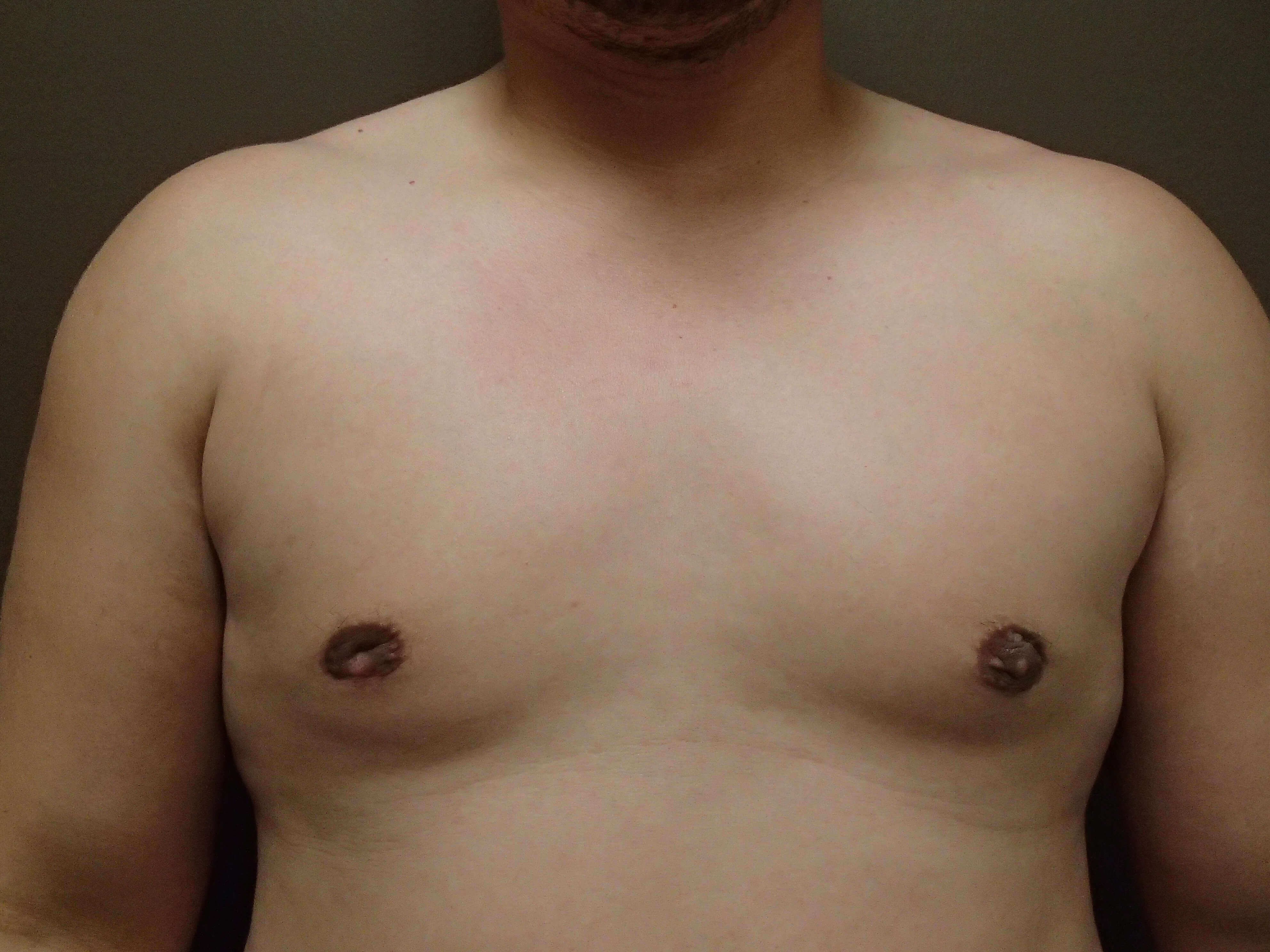 Gynecomastia (male breast redu After