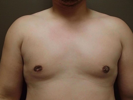 Gynecomastia (male breast redu After