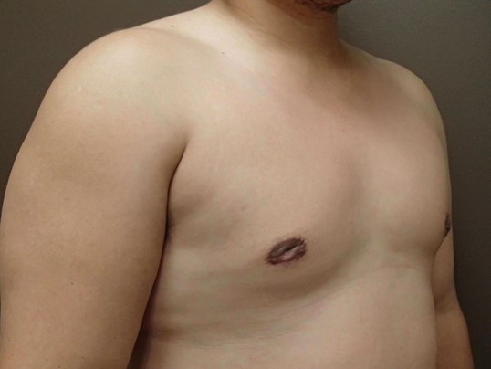 Gynecomastia (male breast redu After