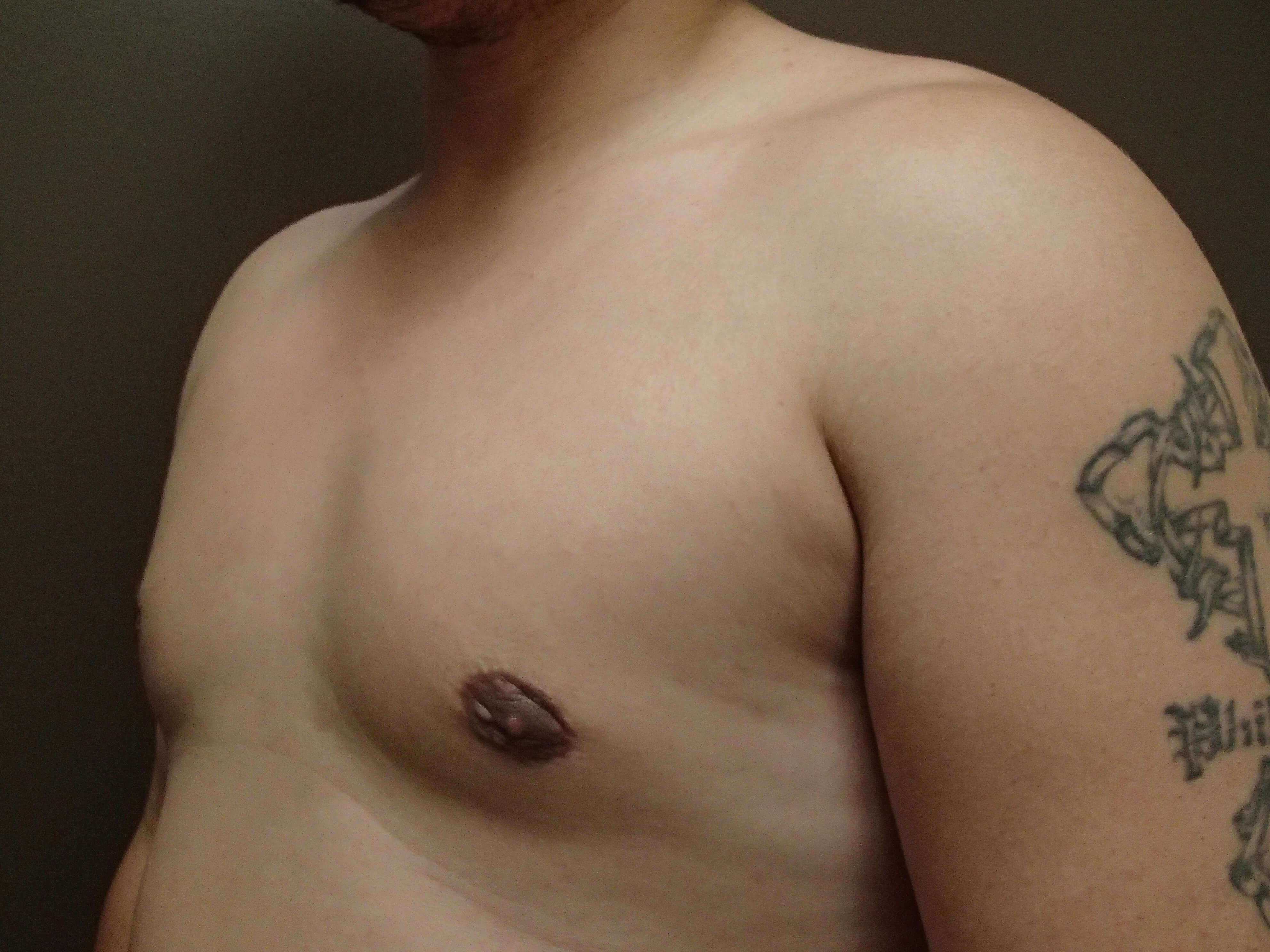 Gynecomastia (male breast redu After
