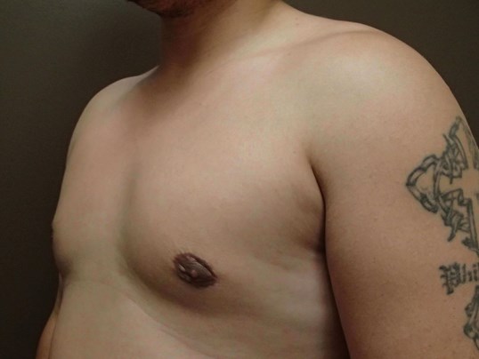 Gynecomastia (male breast redu After