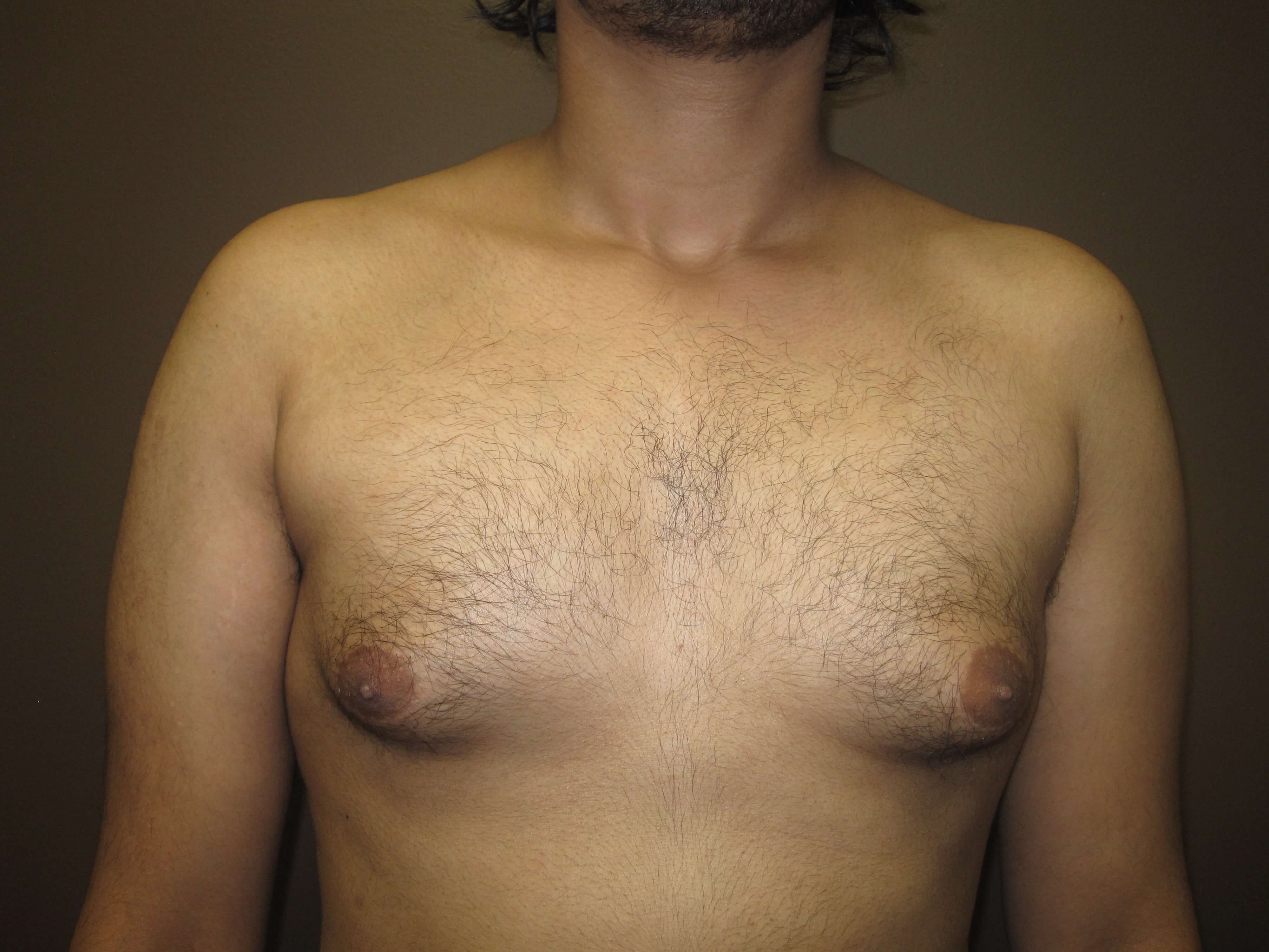 Gynecomastia (male breast redu Before