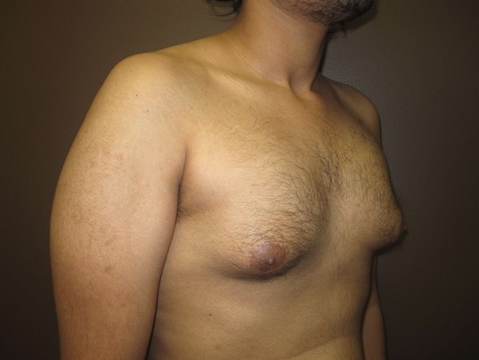 Gynecomastia (male breast redu Before