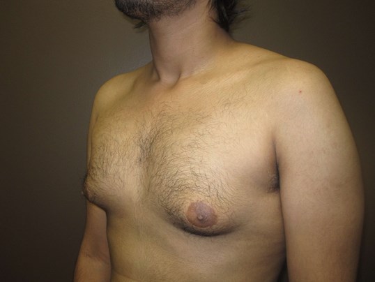 Gynecomastia (male breast redu Before