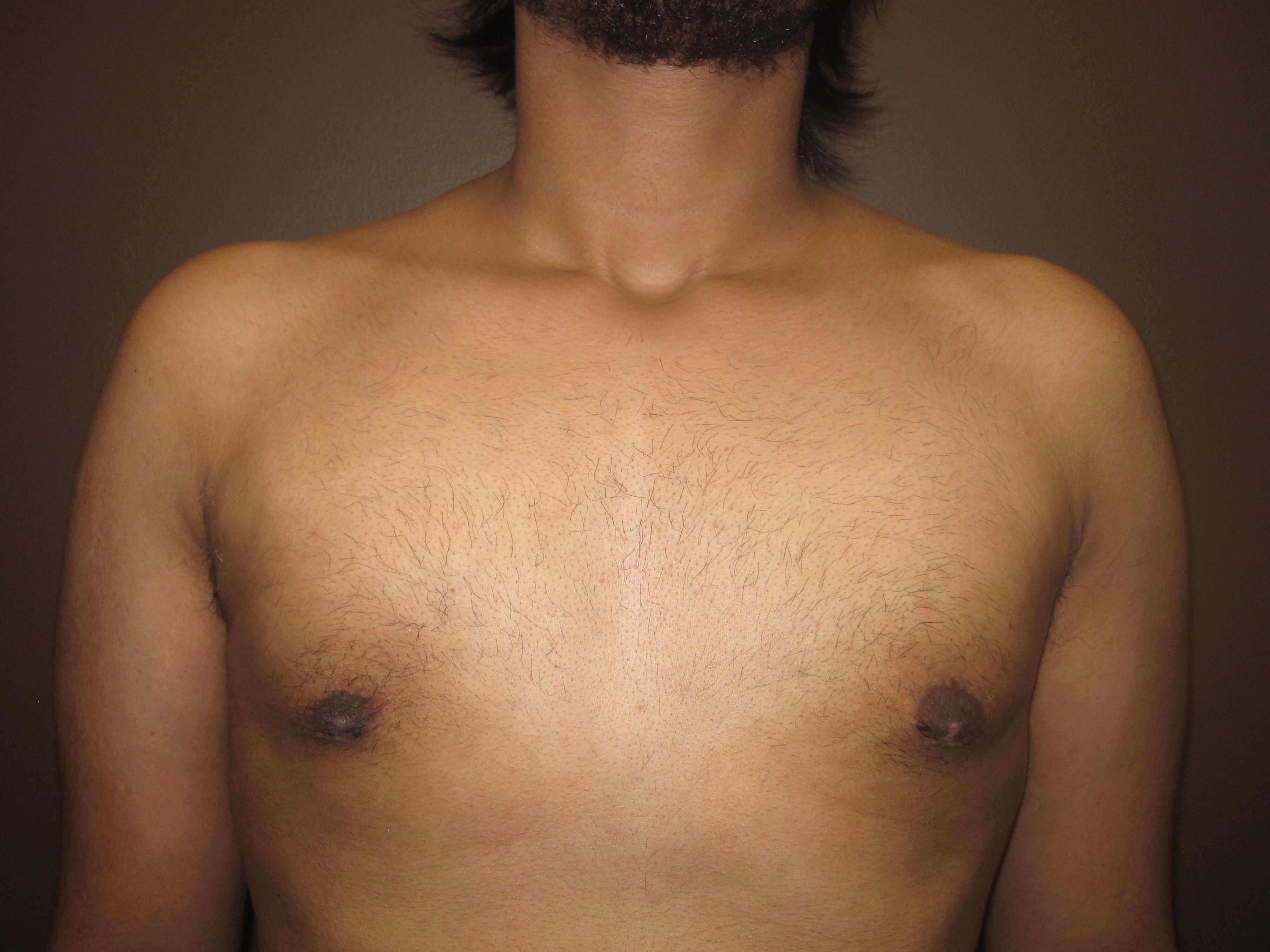 Gynecomastia (male breast redu After