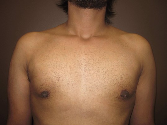 Gynecomastia (male breast redu After