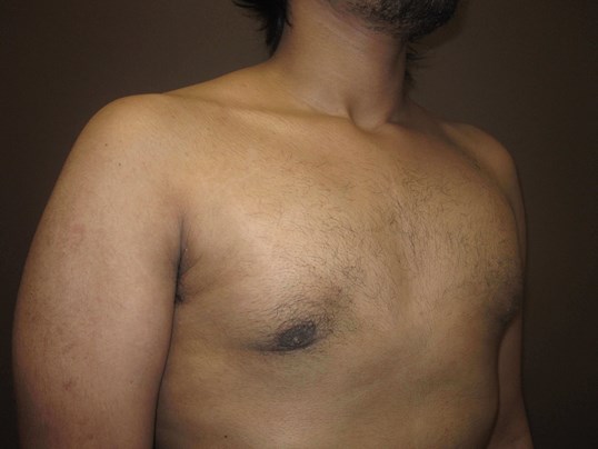 Gynecomastia (male breast redu After