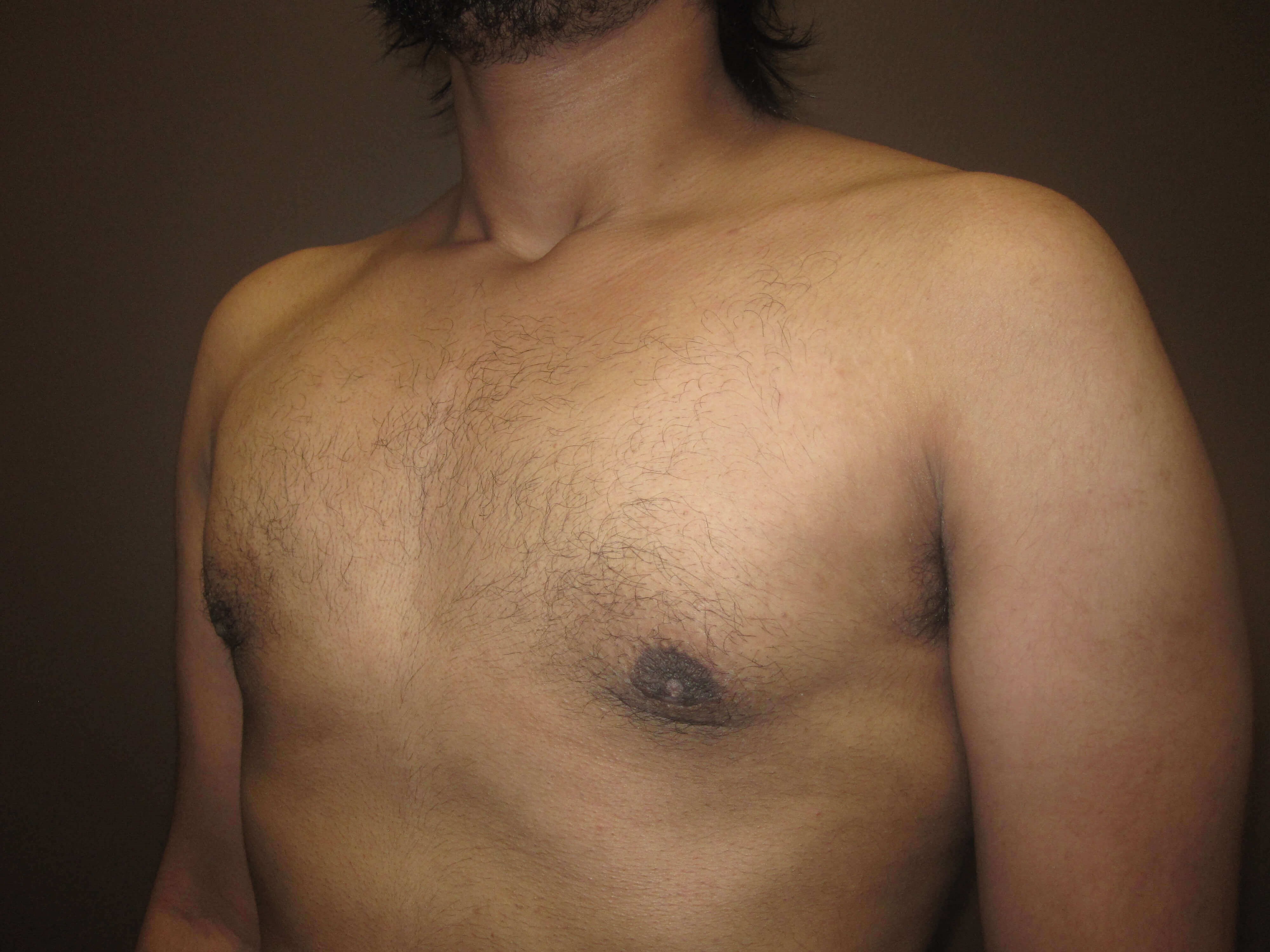 Gynecomastia (male breast redu After