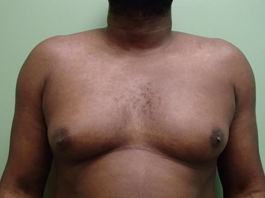 Gynecomastia (male breast redu Before