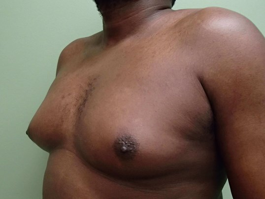 Gynecomastia (male breast redu Before