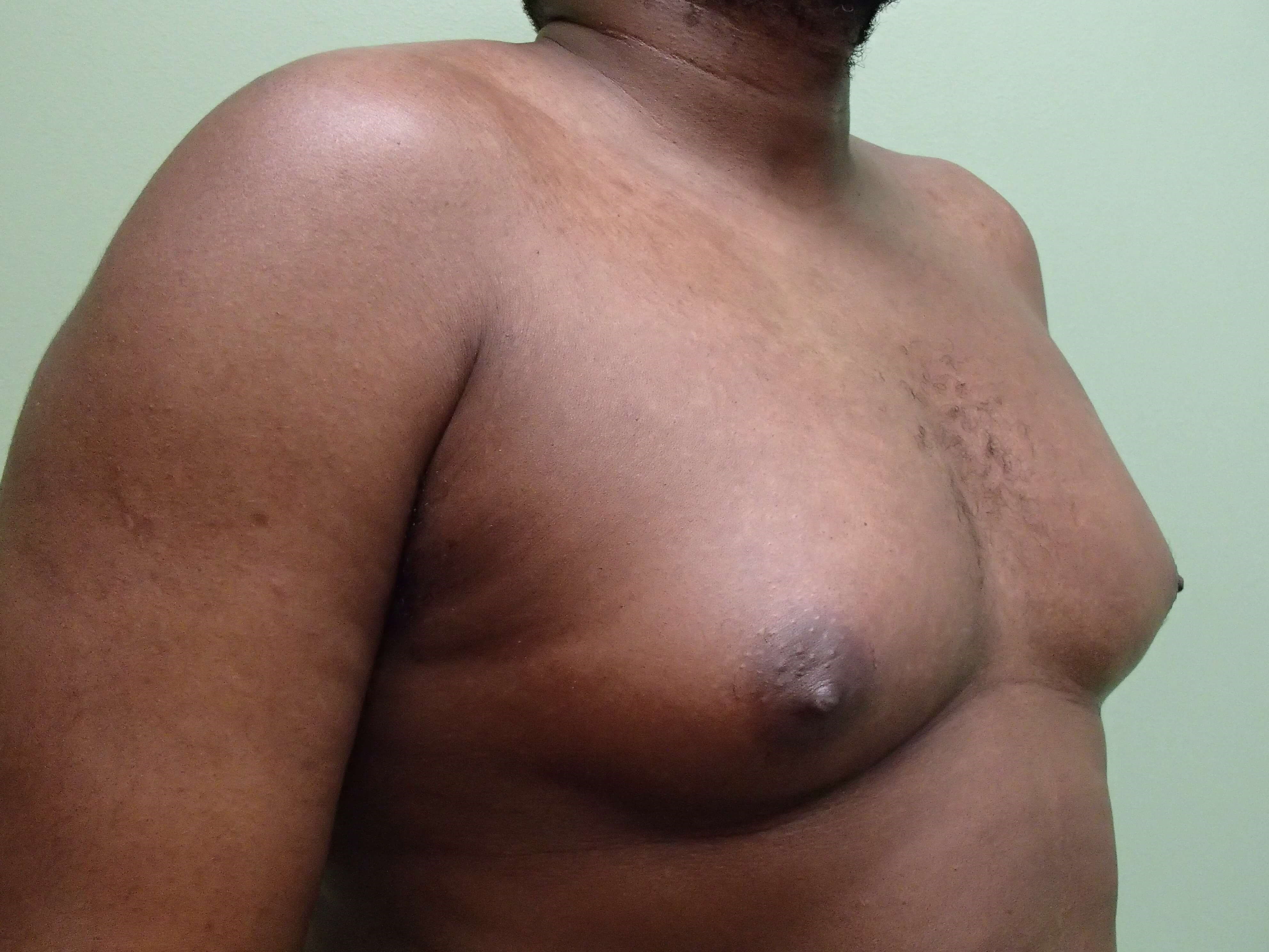 Gynecomastia (male breast redu Before