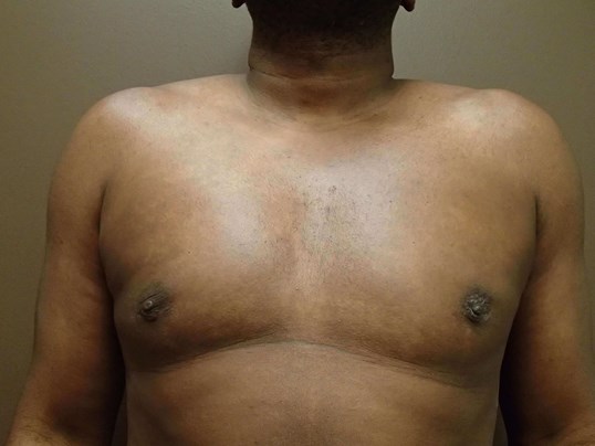 Gynecomastia (male breast redu After
