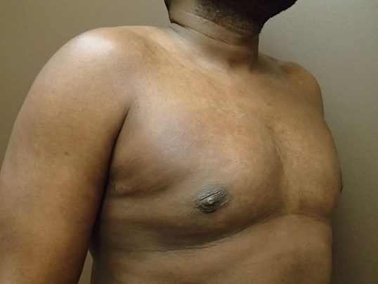 Gynecomastia (male breast redu After