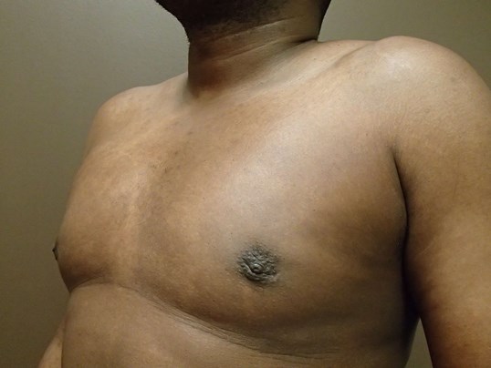 Gynecomastia (male breast redu After