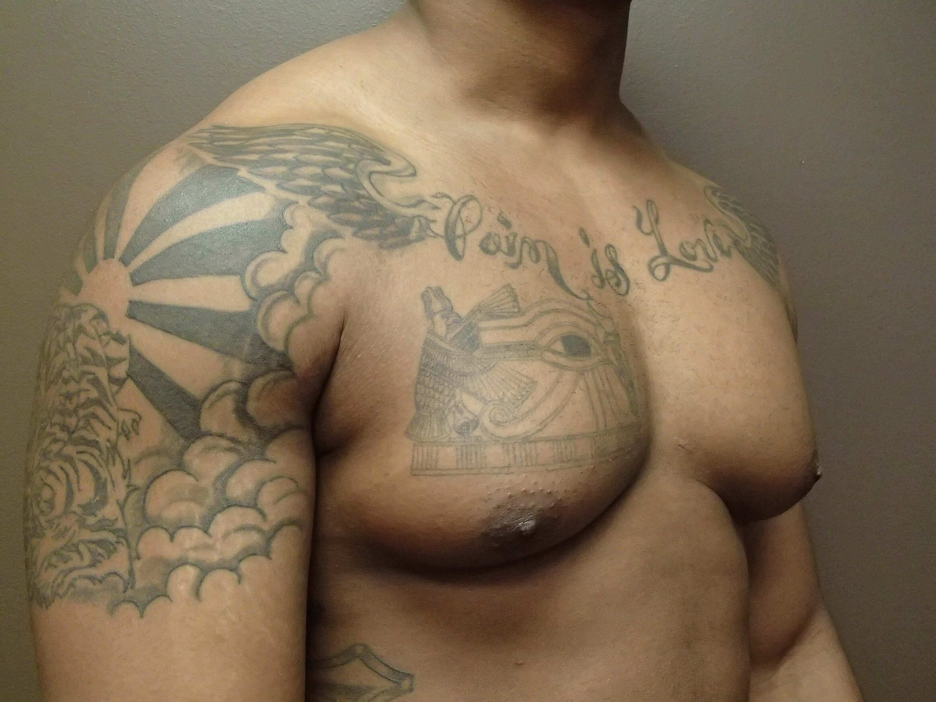 Gynecomastia (male breast redu Before