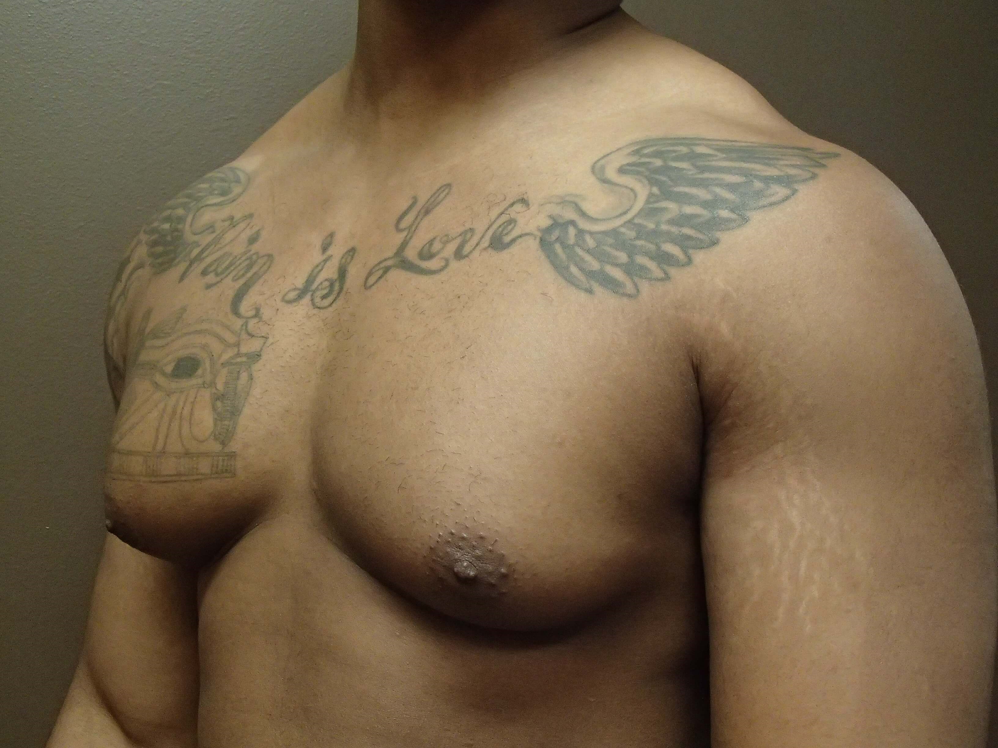 Gynecomastia (male breast redu Before