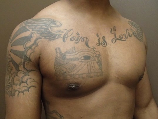 Gynecomastia (male breast redu After