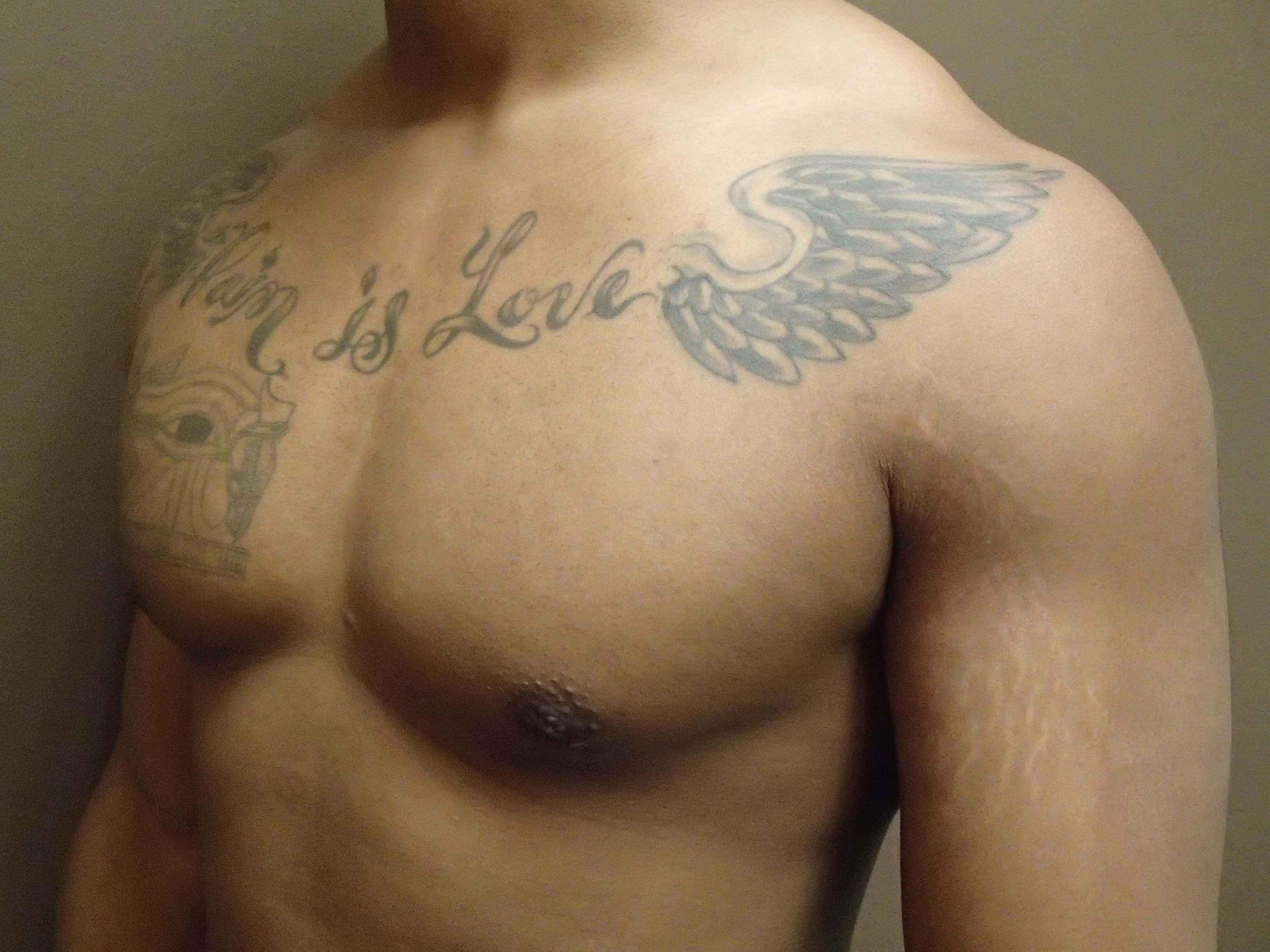 Gynecomastia (male breast redu After
