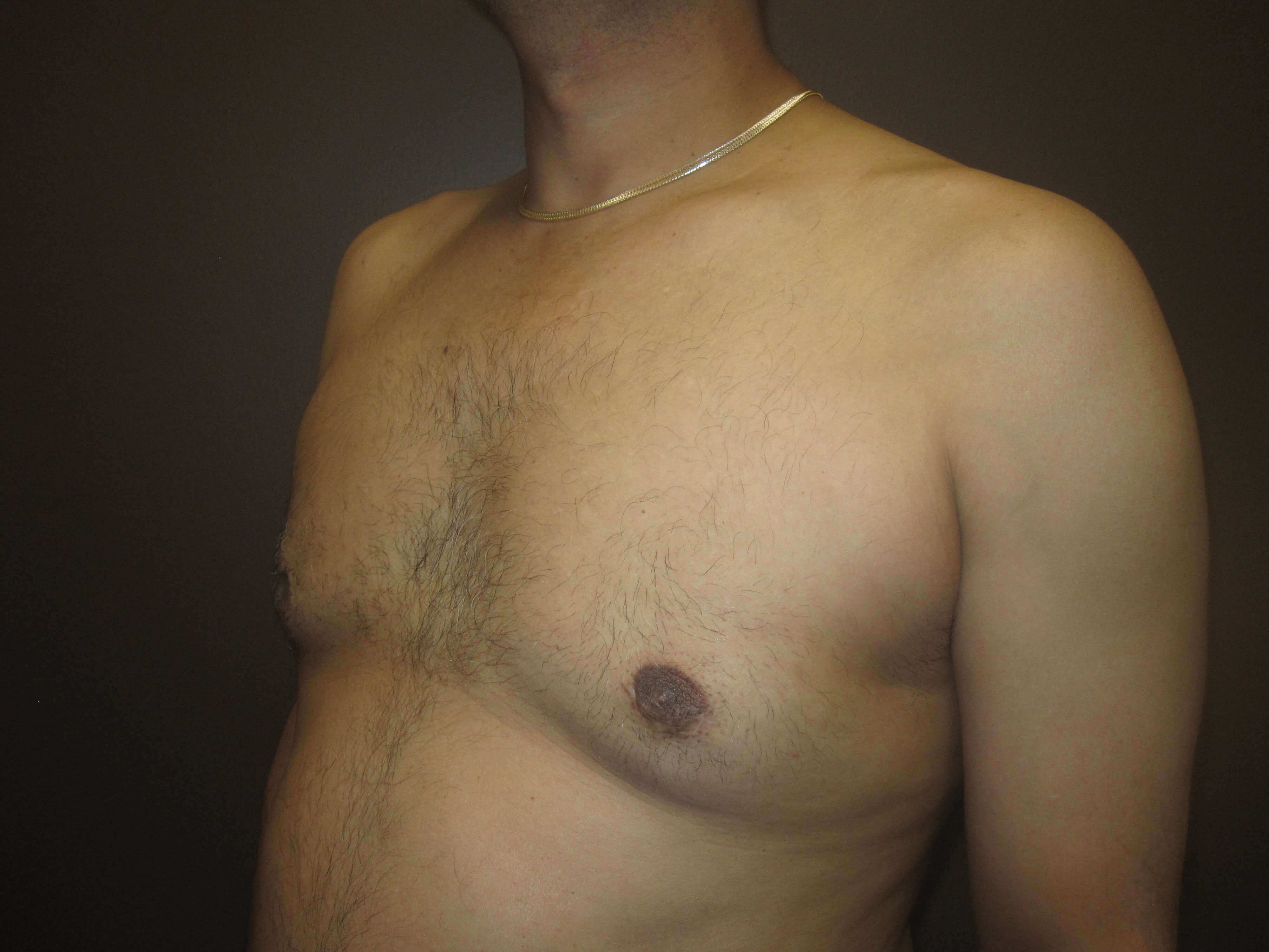 Gynecomastia (male breast redu After