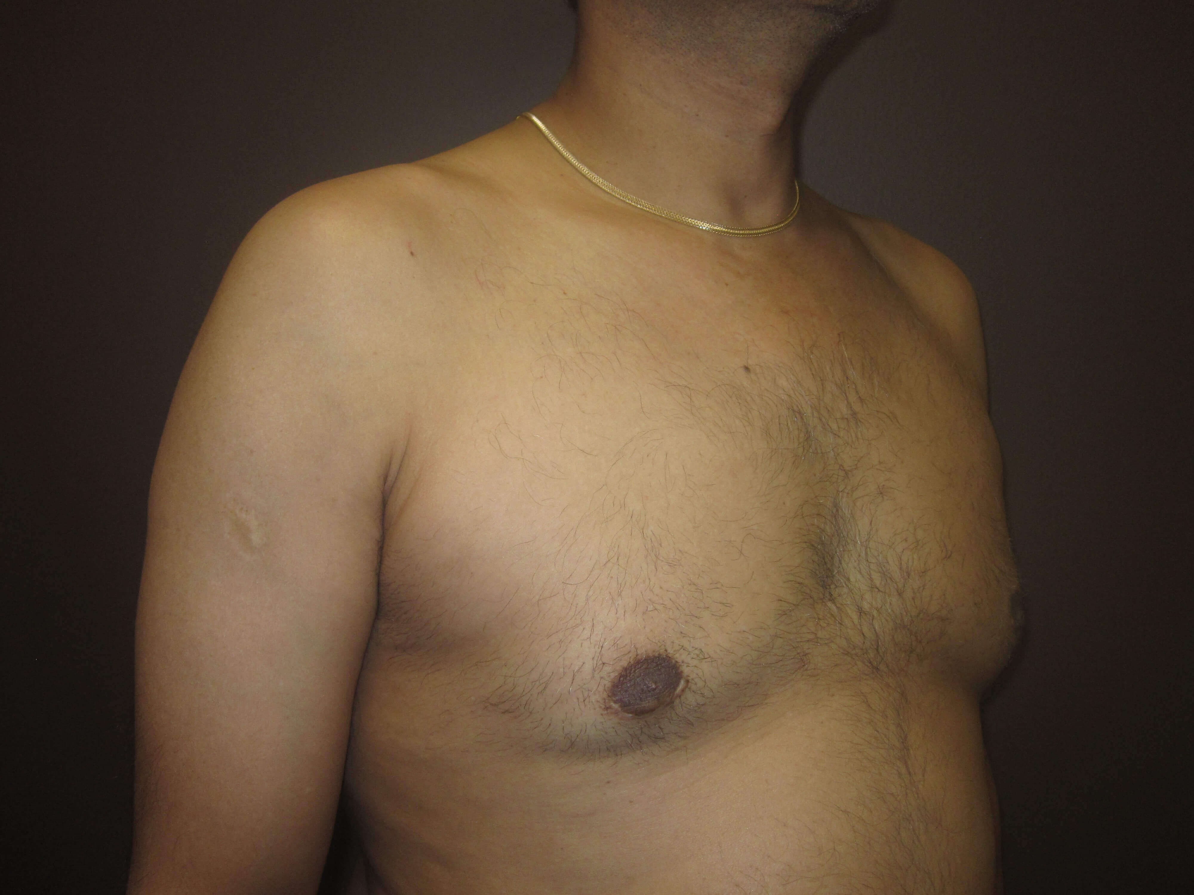 Gynecomastia (male breast redu After
