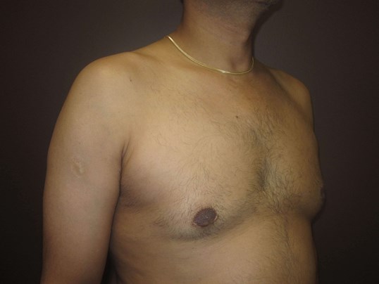 Gynecomastia (male breast redu After