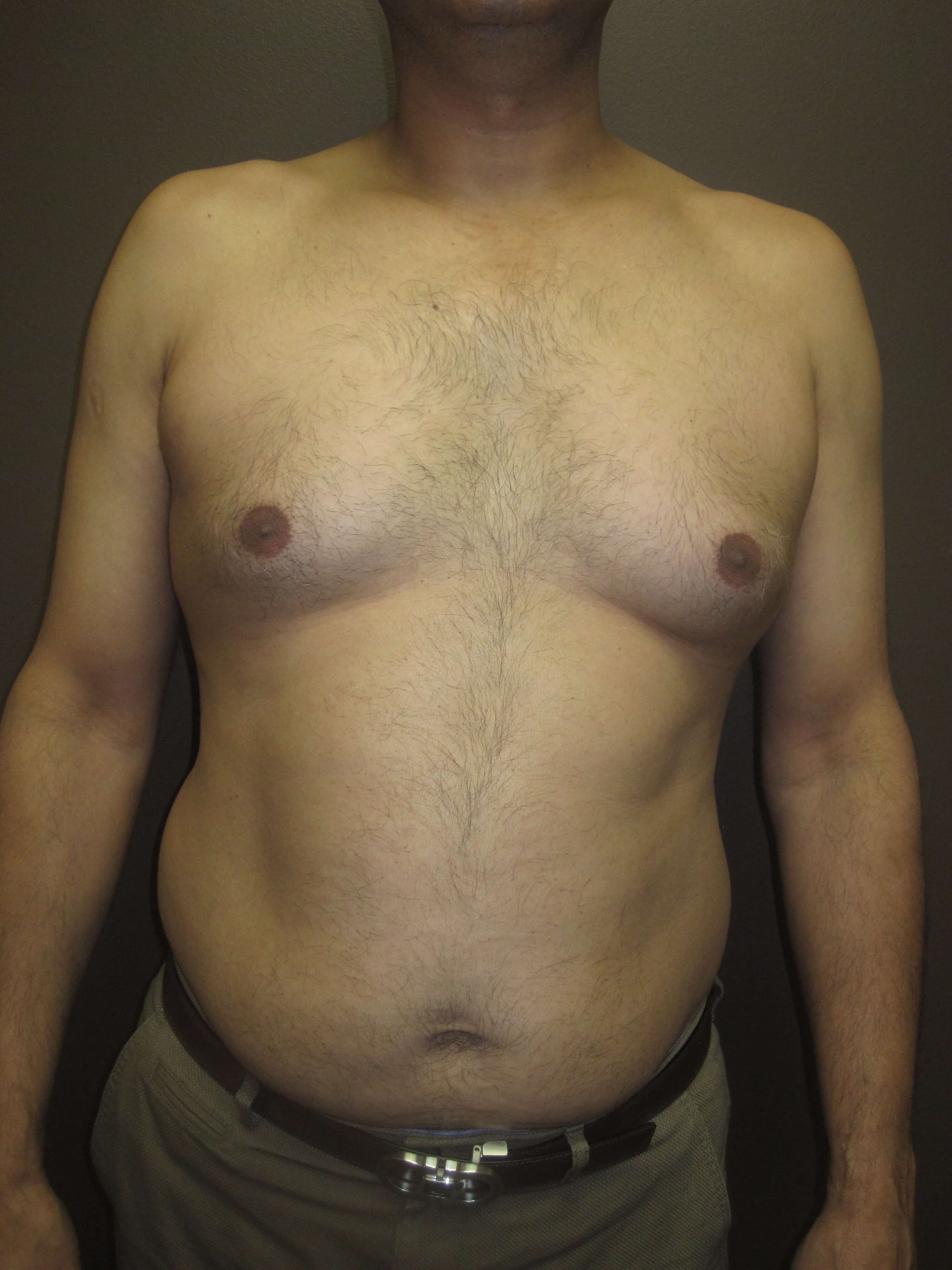 Gynecomastia (male breast redu Before