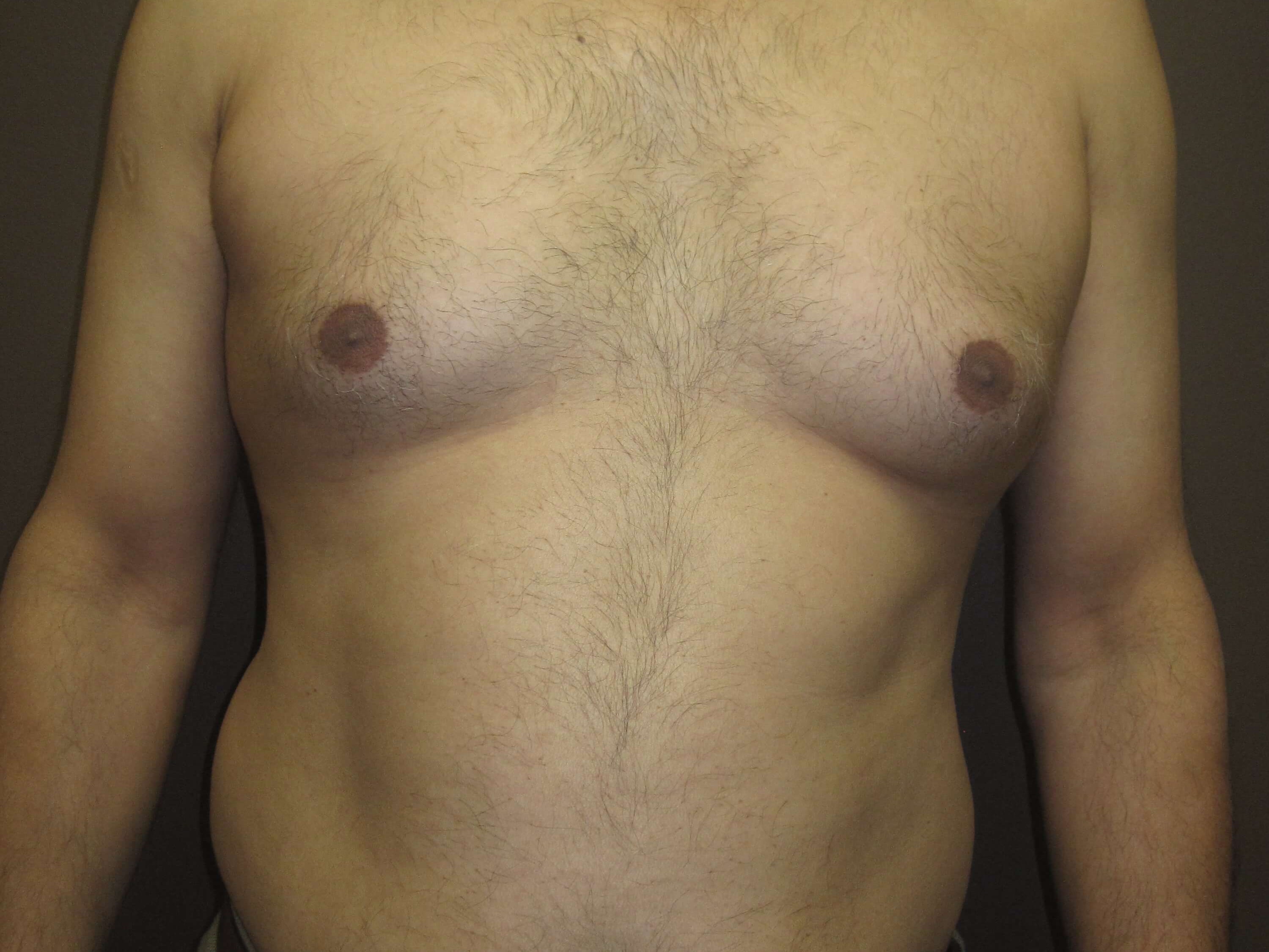 Gynecomastia (male breast redu Before
