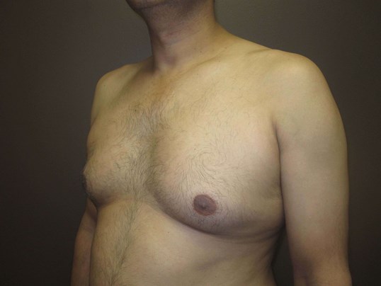 Gynecomastia (male breast redu Before