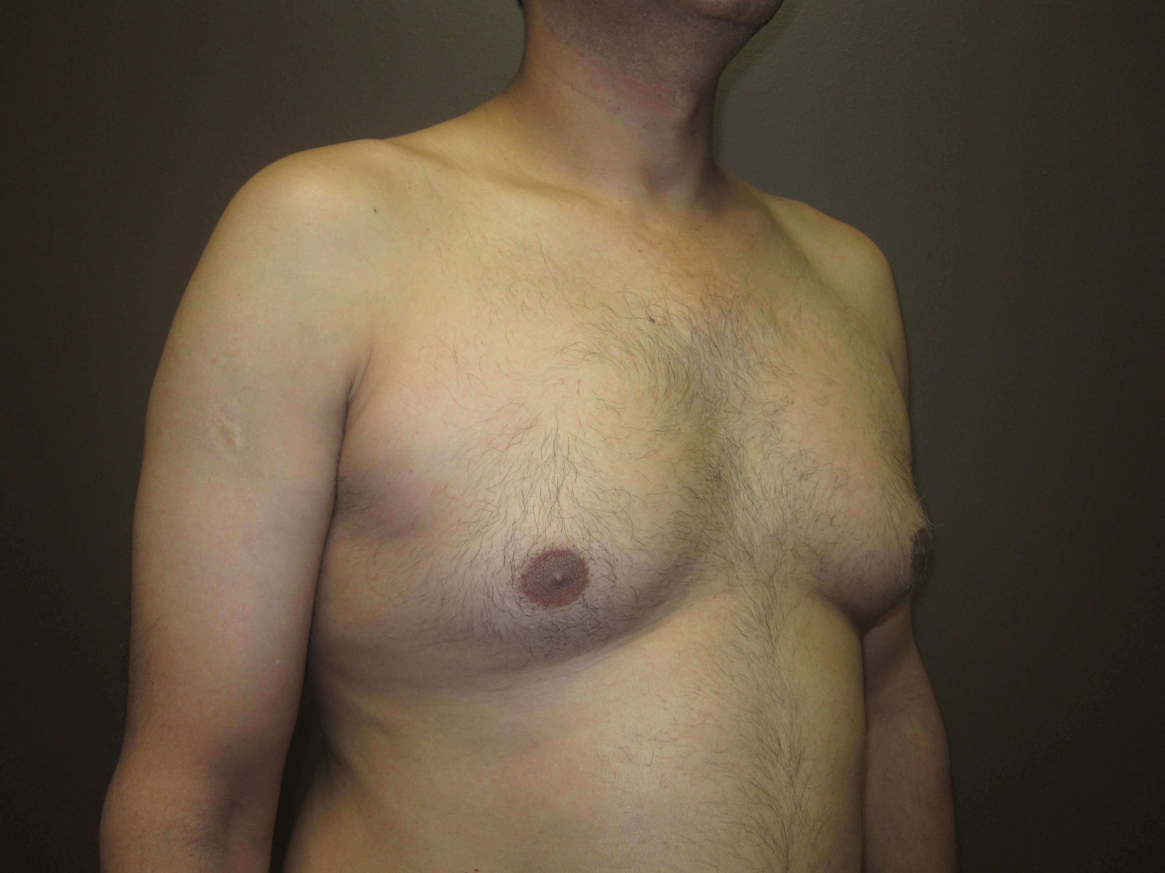 Gynecomastia (male breast redu Before