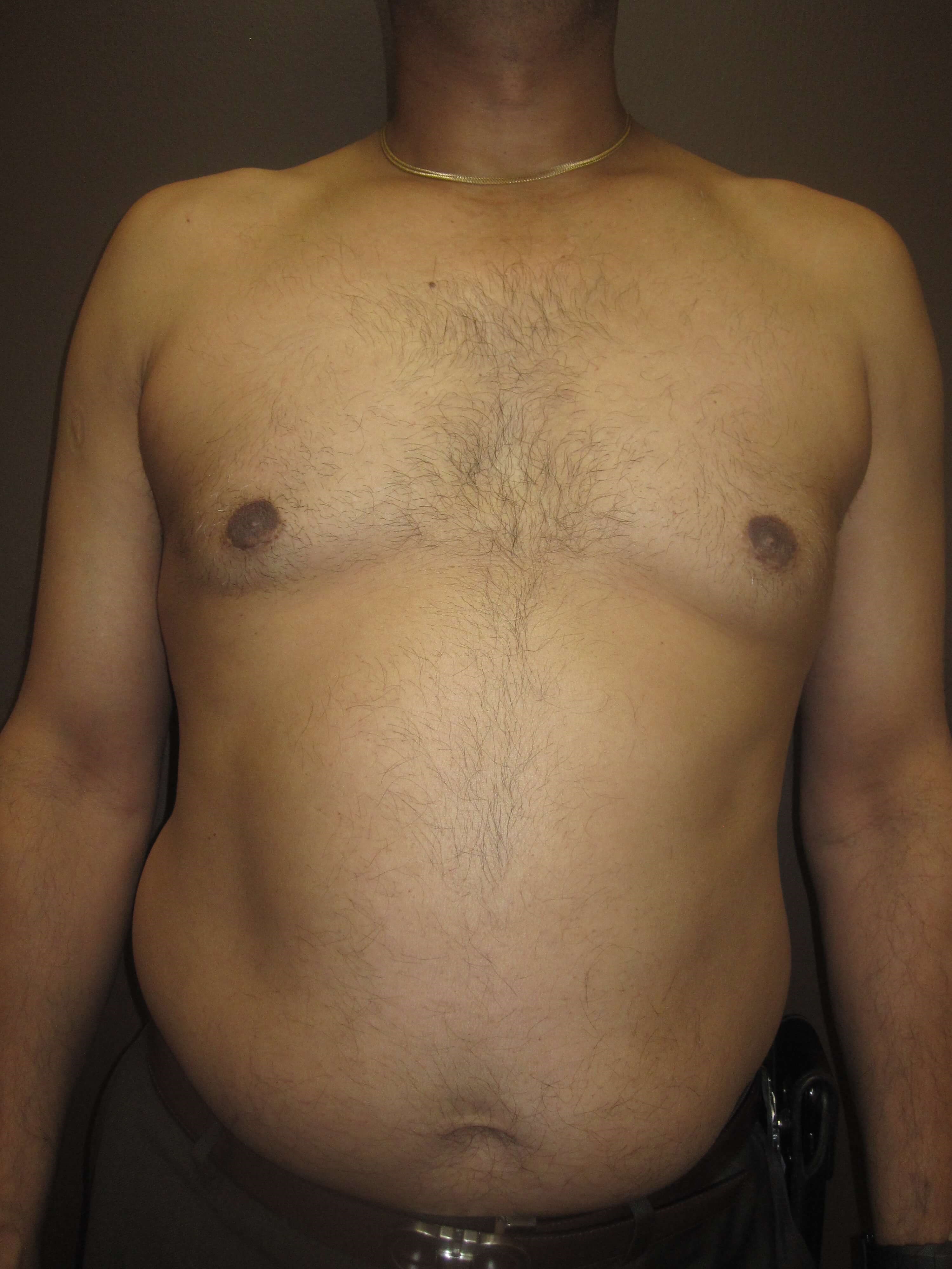 Gynecomastia (male breast redu After