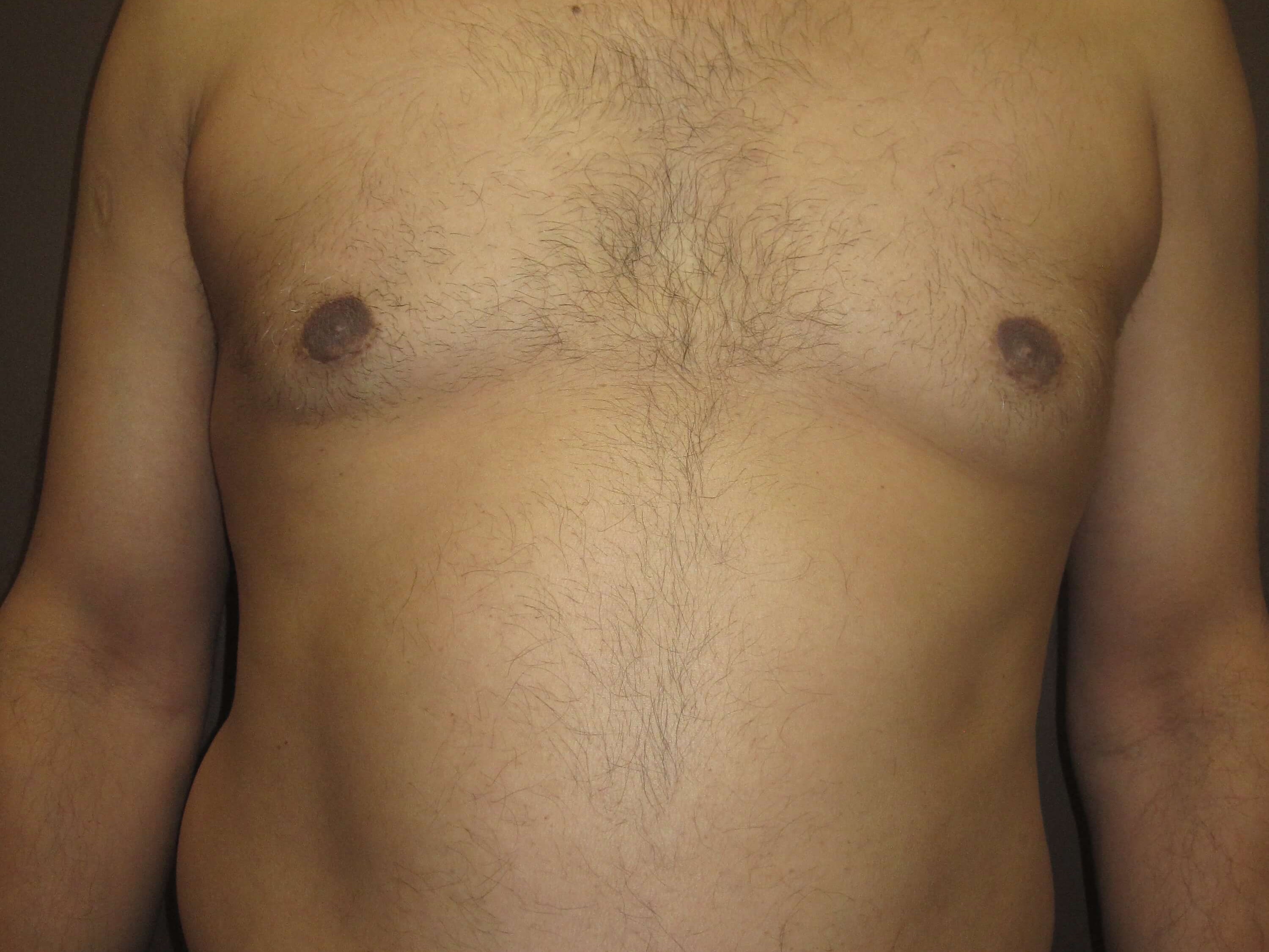 Gynecomastia (male breast redu After