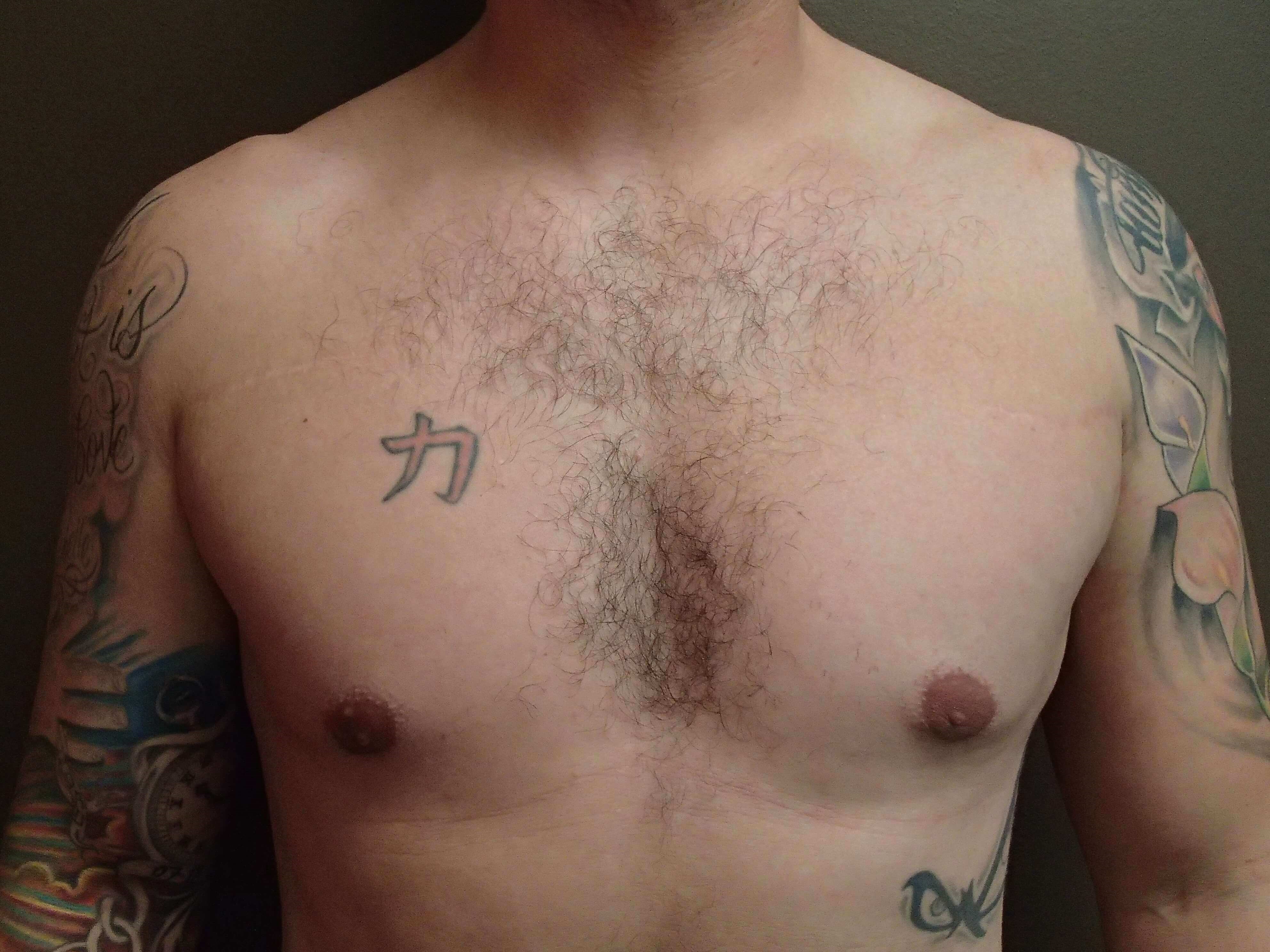 Gynecomastia (male breast redu After