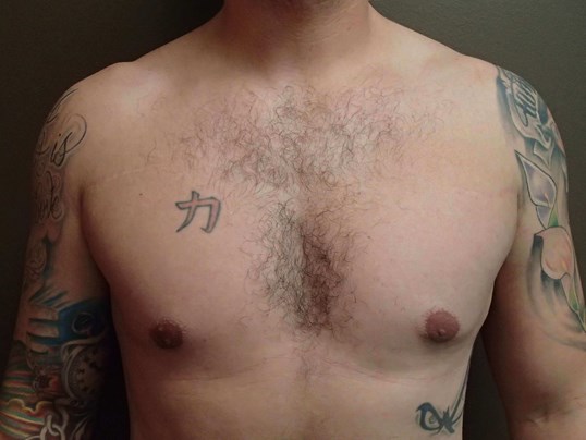 Gynecomastia (male breast redu After