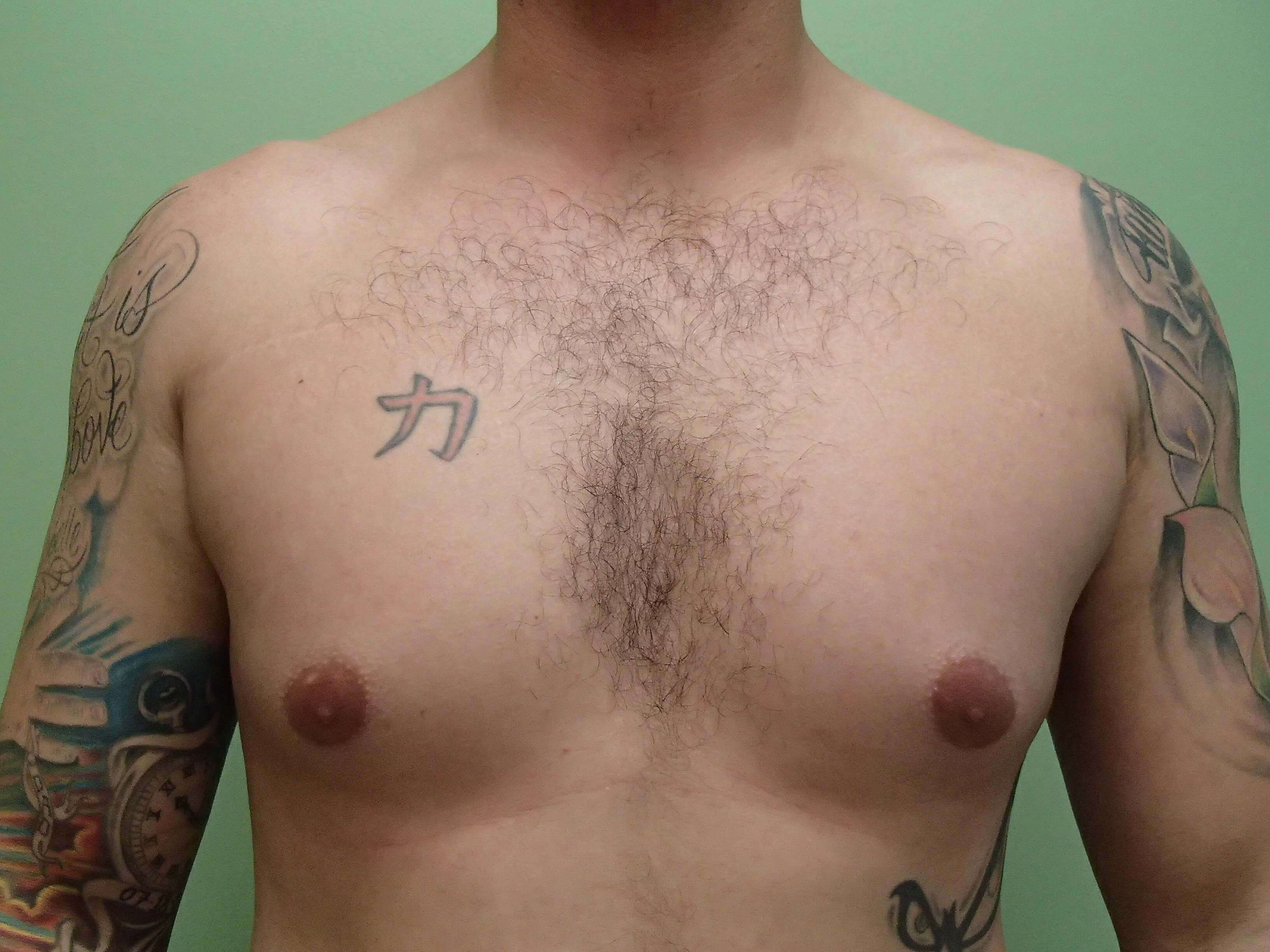 Gynecomastia (male breast redu Before