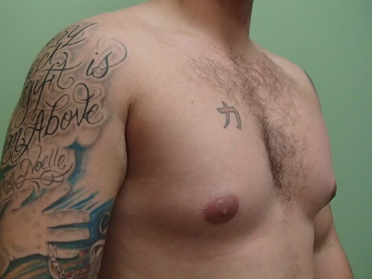 Gynecomastia (male breast redu Before