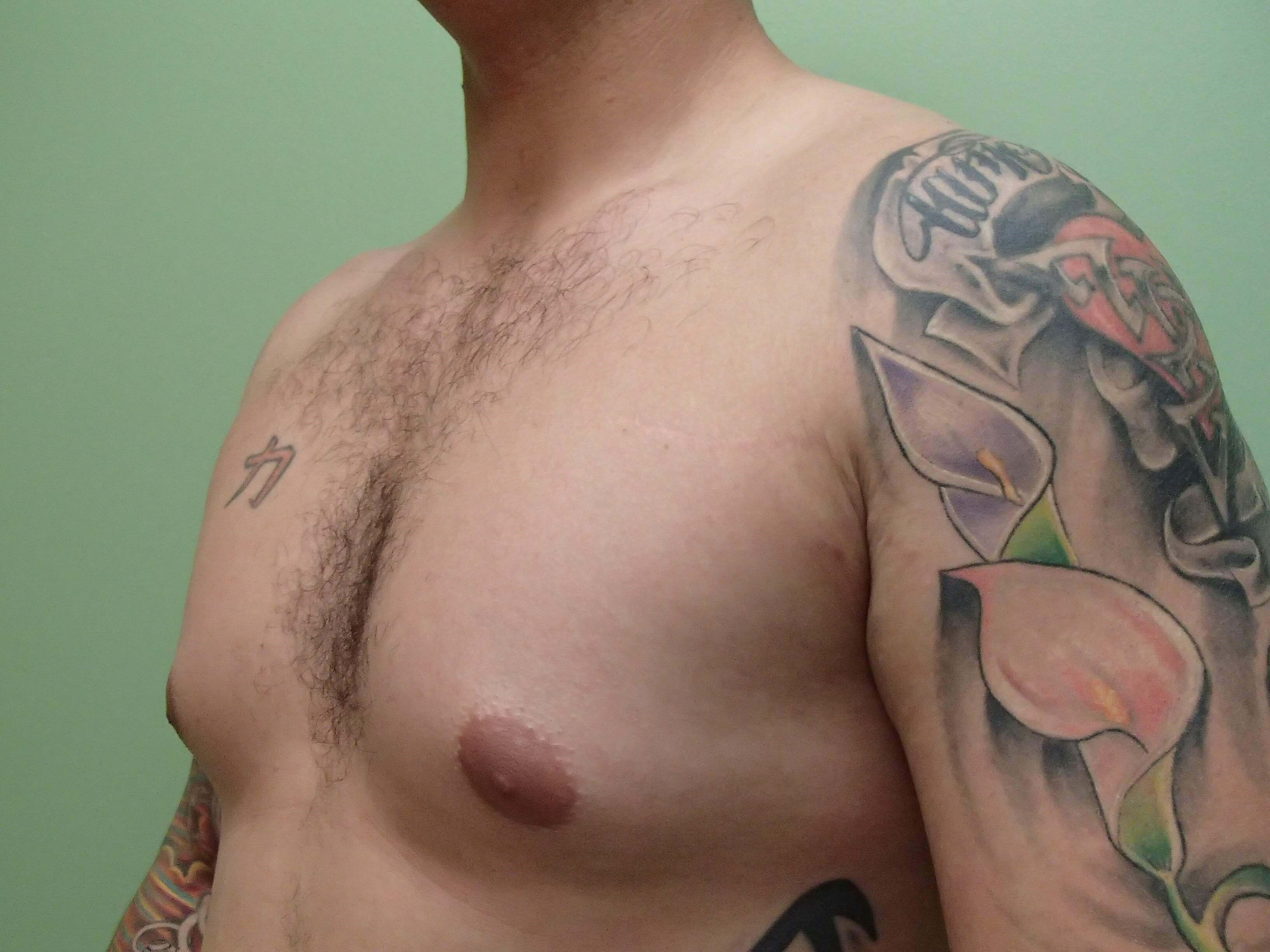 Gynecomastia (male breast redu Before