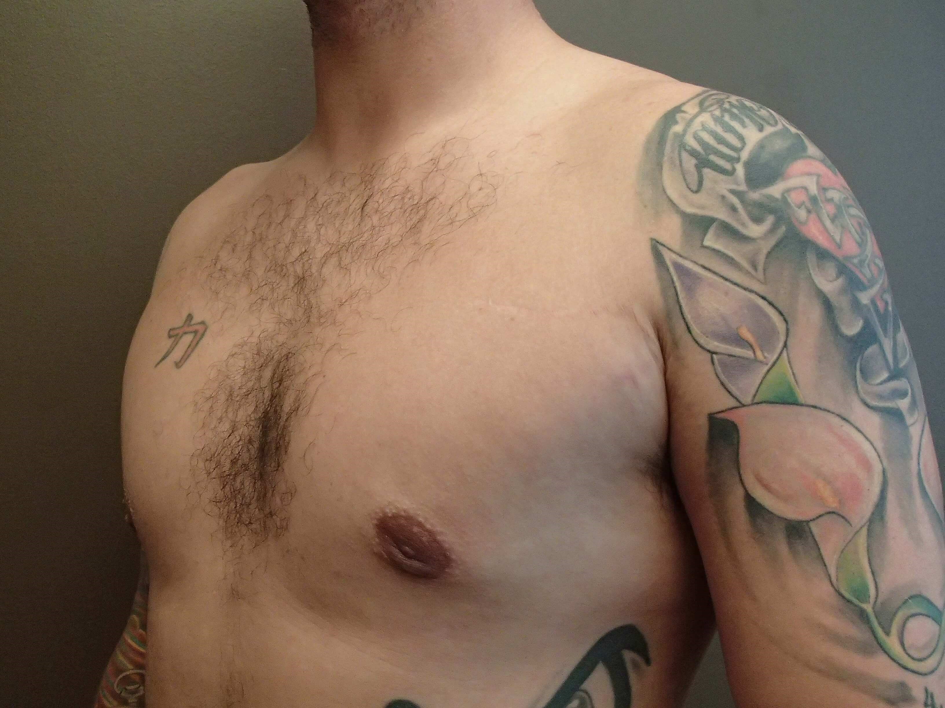 Gynecomastia (male breast redu After