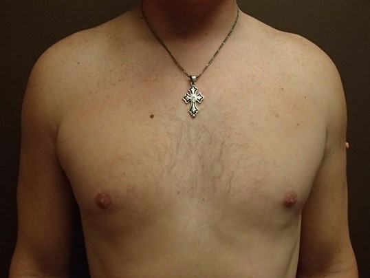 Gynecomastia (male breast redu After