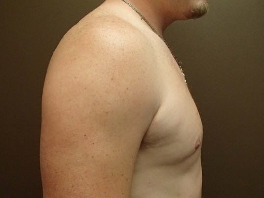 Gynecomastia (male breast redu After