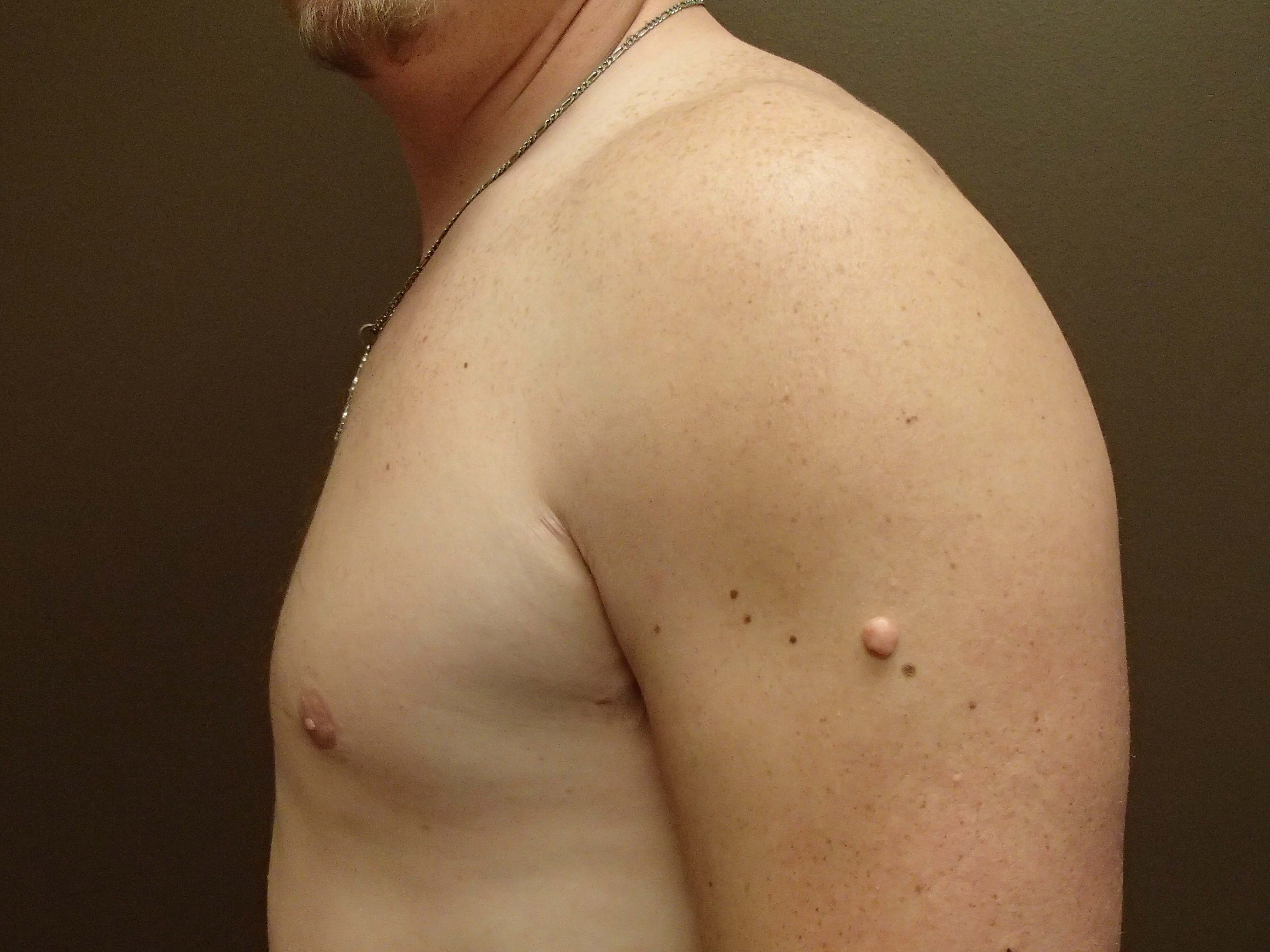 Gynecomastia (male breast redu After
