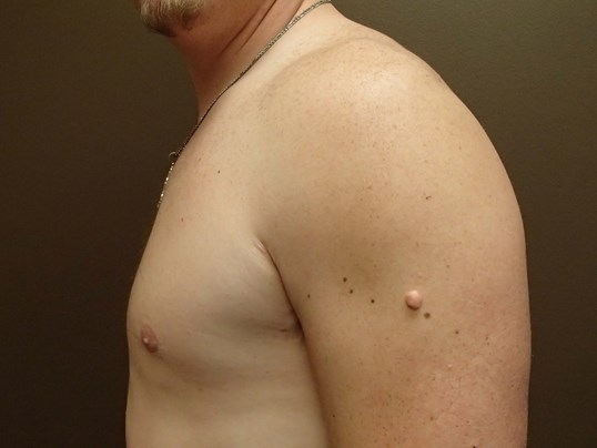 Gynecomastia (male breast redu After