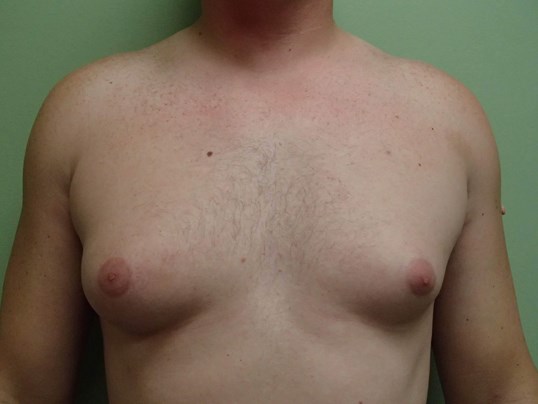 Gynecomastia (male breast redu Before