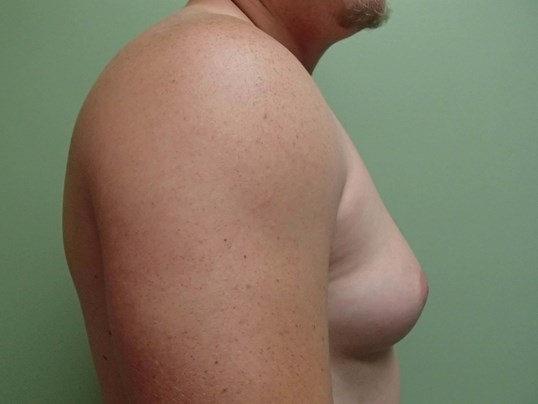 Gynecomastia (male breast redu Before