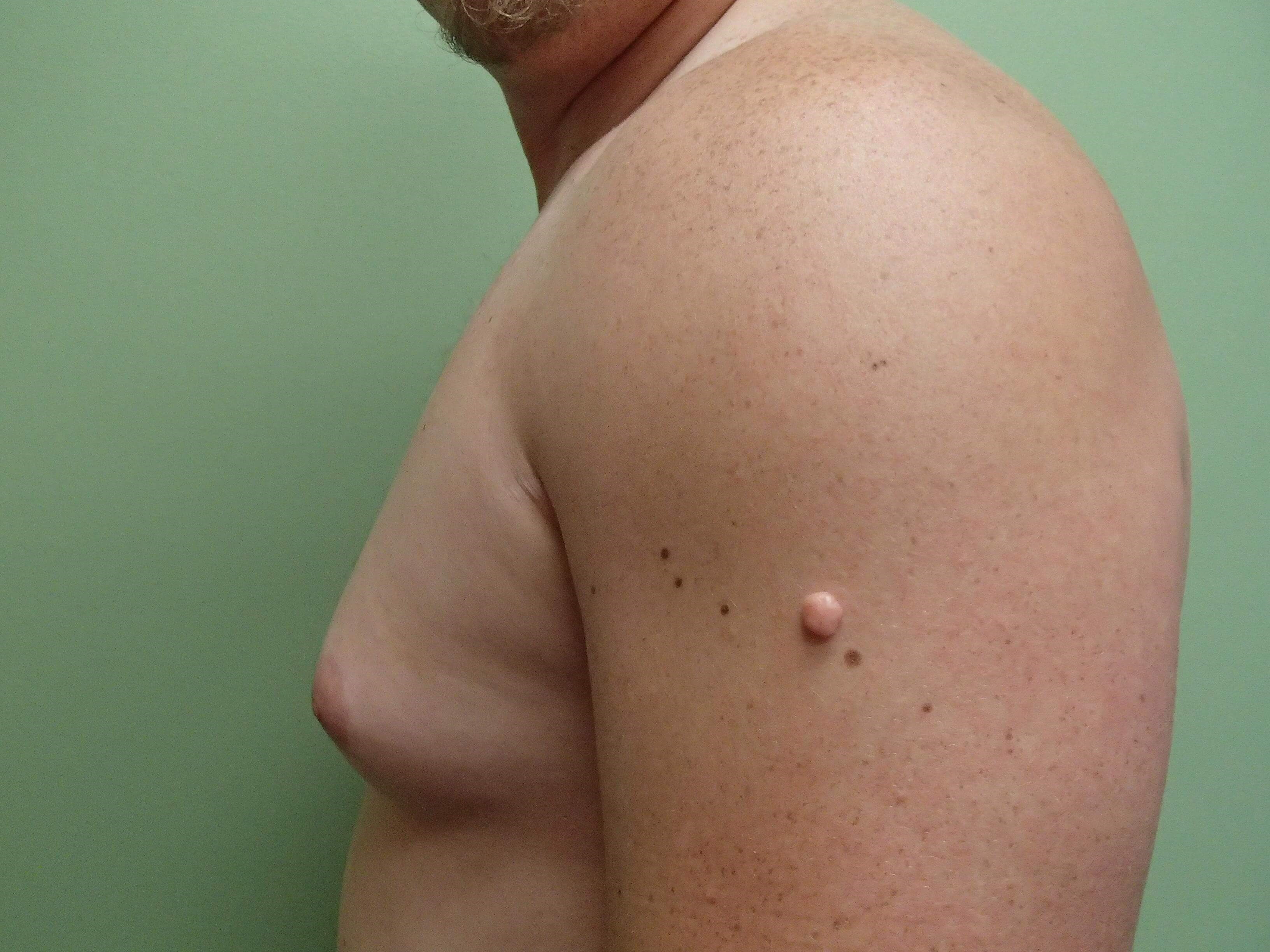 Gynecomastia (male breast redu Before